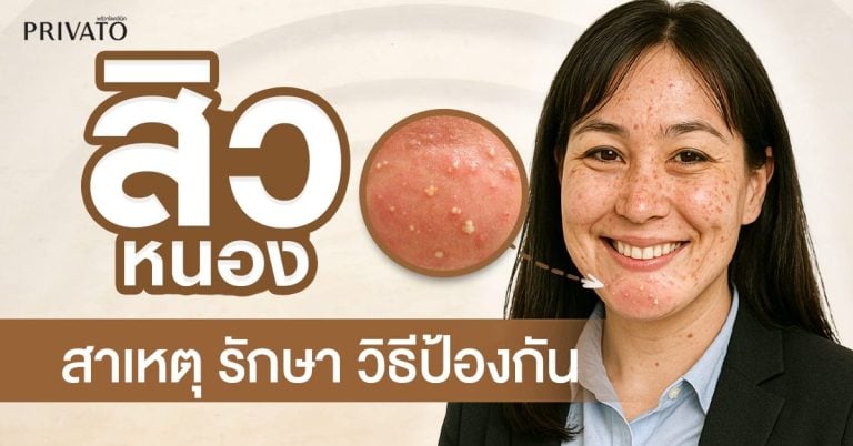 สิวหนอง: สาเหตุ การรักษา และวิธีป้องกันที่ถูกต้อง