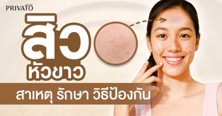 สิวหัวขาว: สาเหตุ วิธีรักษา และการป้องกันที่ถูกต้อง
