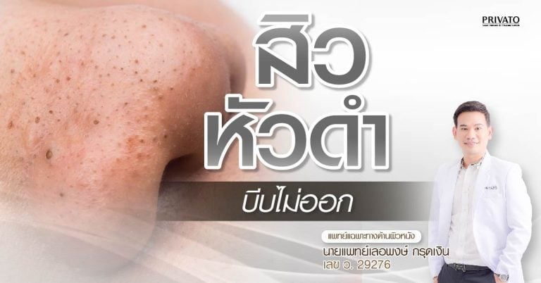 สิวหัวดำบีบไม่ออก ทำไมบีบยาก? แนวทางดูแลและทางเลือกแทนการบีบ