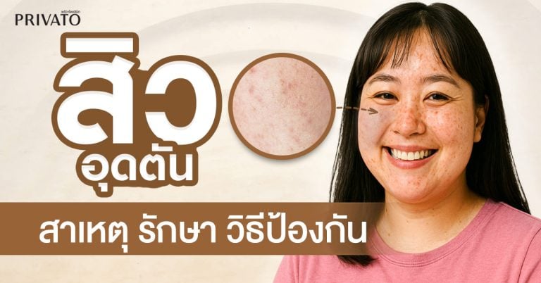สิวอุดตัน: สาเหตุ การรักษา และวิธีป้องกันที่ถูกต้อง