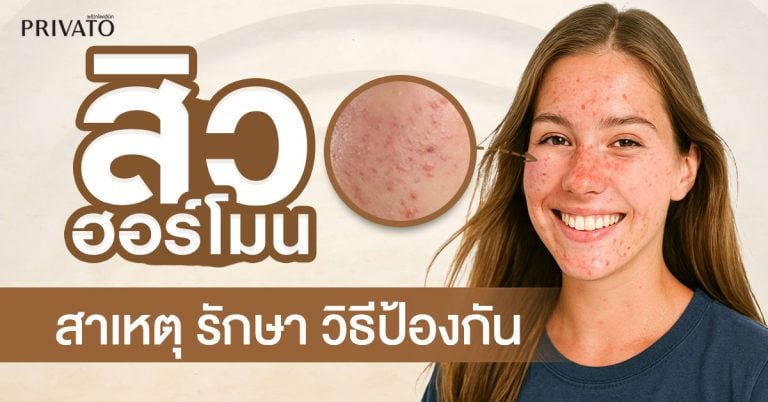 สิวฮอร์โมน: สาเหตุ การรักษา และวิธีป้องกันที่ถูกต้อง