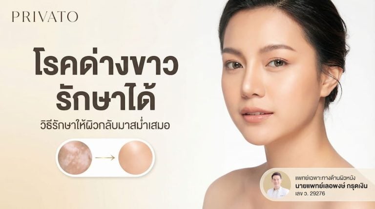 โรคด่างขาว (Vitiligo) คืออะไร สาเหตุ อาการ วิธีรักษาสีผิวให้สม่ำเสมอ