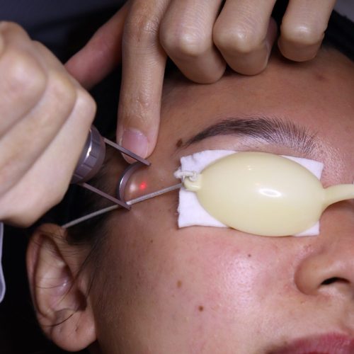 ลูกค้ากำลังเข้ารับบริการโปรแกรมเลเซอร์ผิวหน้า M-White Laser (Close-up)